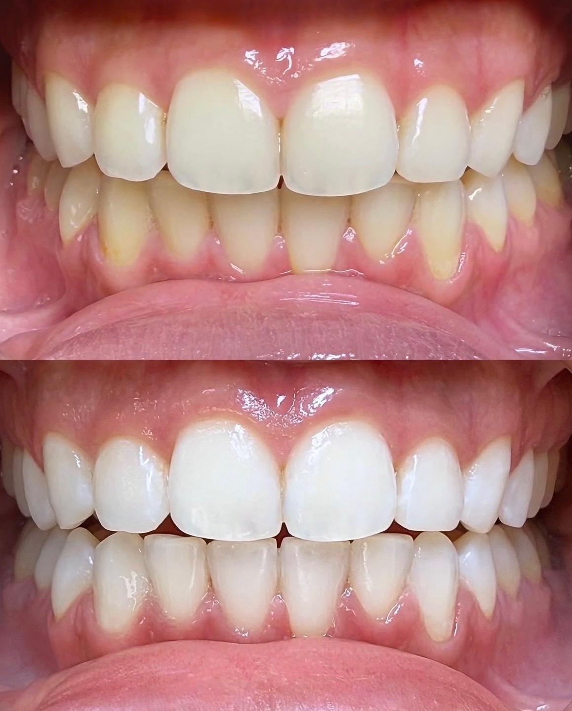 Before and after teeth whitening result 1